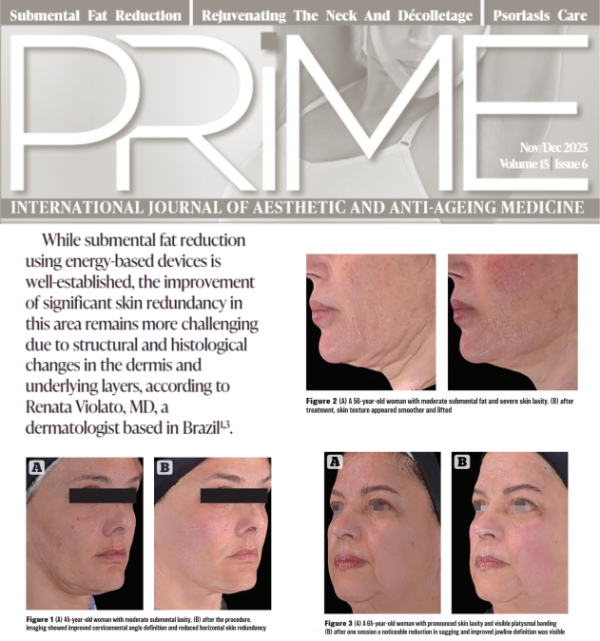 Renata Violato Médica Dermatologista SBD, Global Key Opnion Leader Classys Speaker/Palestrante Ultraformer MPT e Volnewmer. Professora Médicos Pós Graduação Hospital Albert Einsten Lasers.   Diversas Tecnologias na Clínica: Volnewmer, Ultraforme MPT, Laser Chrome, Coolsculpting, Endymed, Aquapure, Hyper Slim, Soprano, Quantificare e mais.